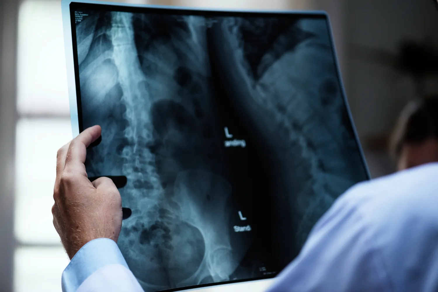 Cirugía de tumores de columna en Zapopan, Jalisco: Precisión y cuidado neuroquirúrgico