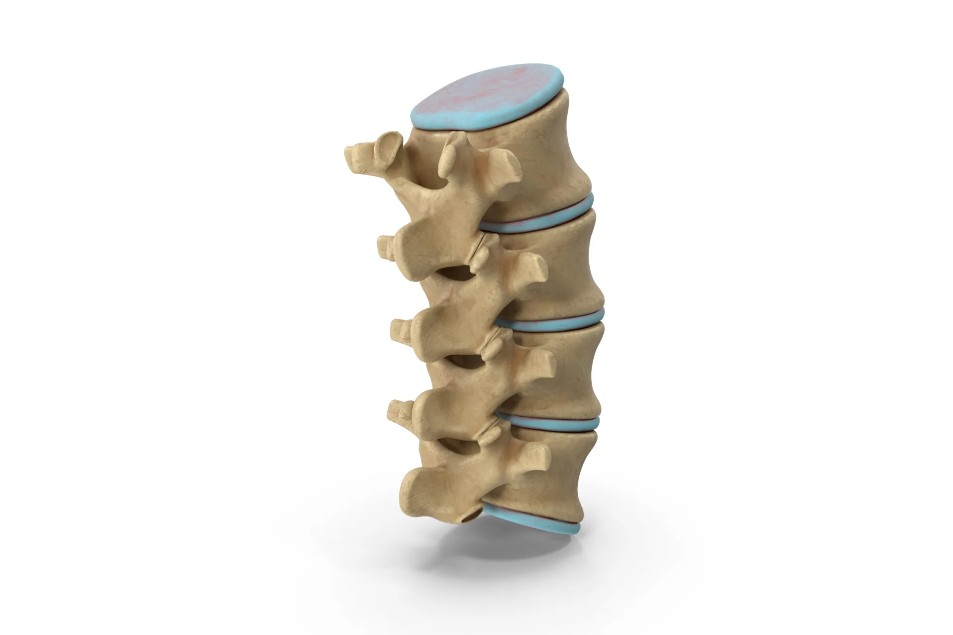 Evaluación de hernia de disco